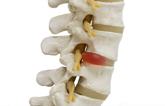 Diagram of herniated disc in spinal cloumn